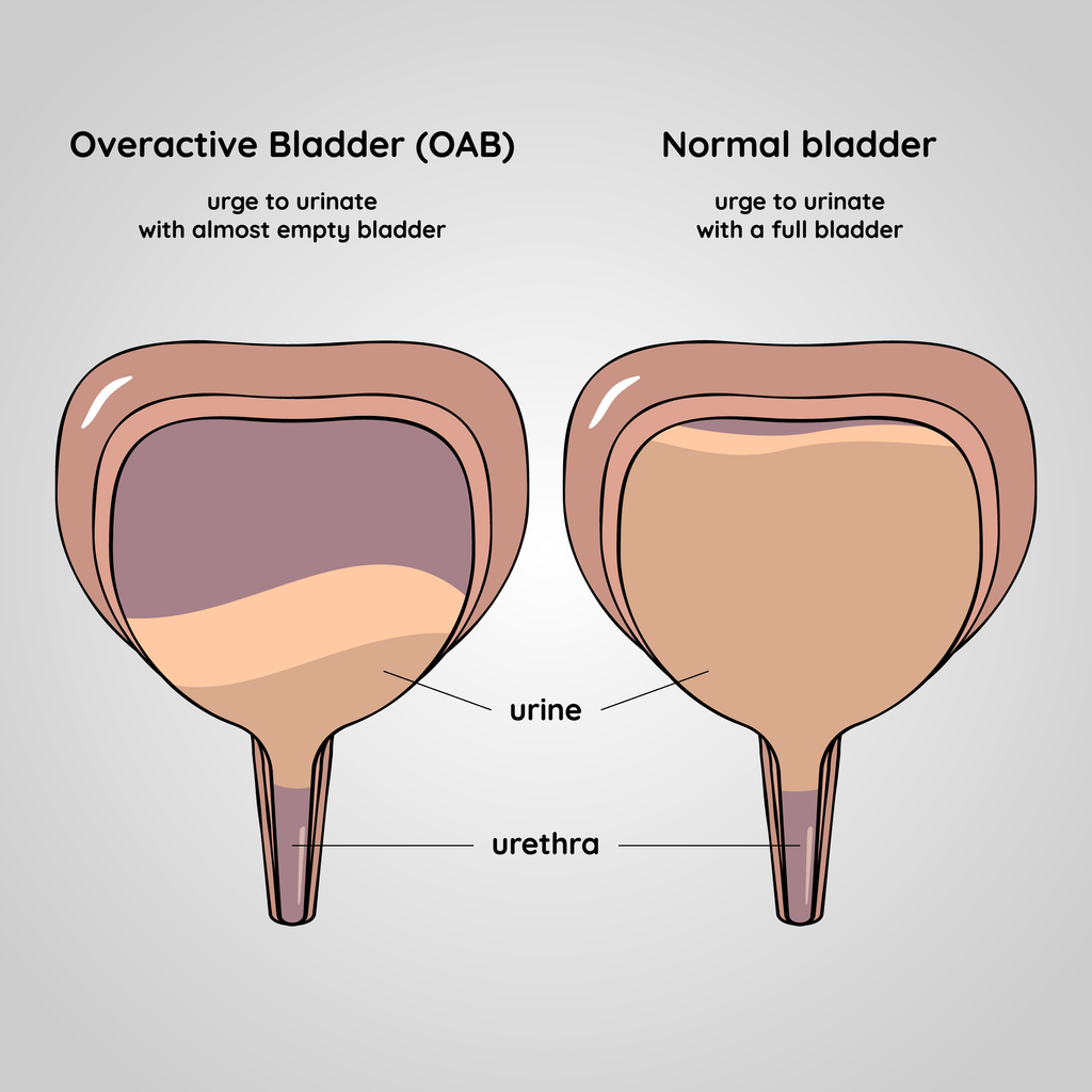 Overactive Bladder Doesn T Have To Control Your Life Ms Urology