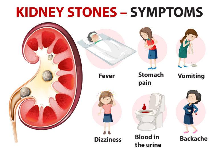 kidney stone pain location